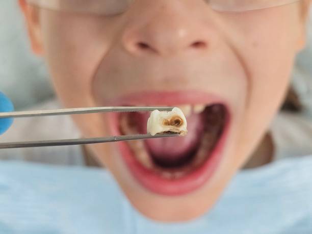 Best Emergency Dentist for Knocked-Out Tooth in Souderton, PA
